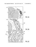 PAIN MANAGEMENT WITH STIMULATION SUBTHRESHOLD TO PARESTHESIA diagram and image