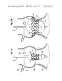 PROSTHETIC HEART VALVE SYSTEM diagram and image