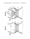 PROSTHETIC HEART VALVE SYSTEM diagram and image