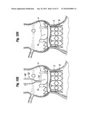 PROSTHETIC HEART VALVE SYSTEM diagram and image