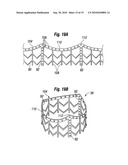 PROSTHETIC HEART VALVE SYSTEM diagram and image