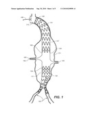 Stent Graft diagram and image