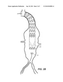 Stent Graft diagram and image