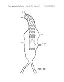 Stent Graft diagram and image
