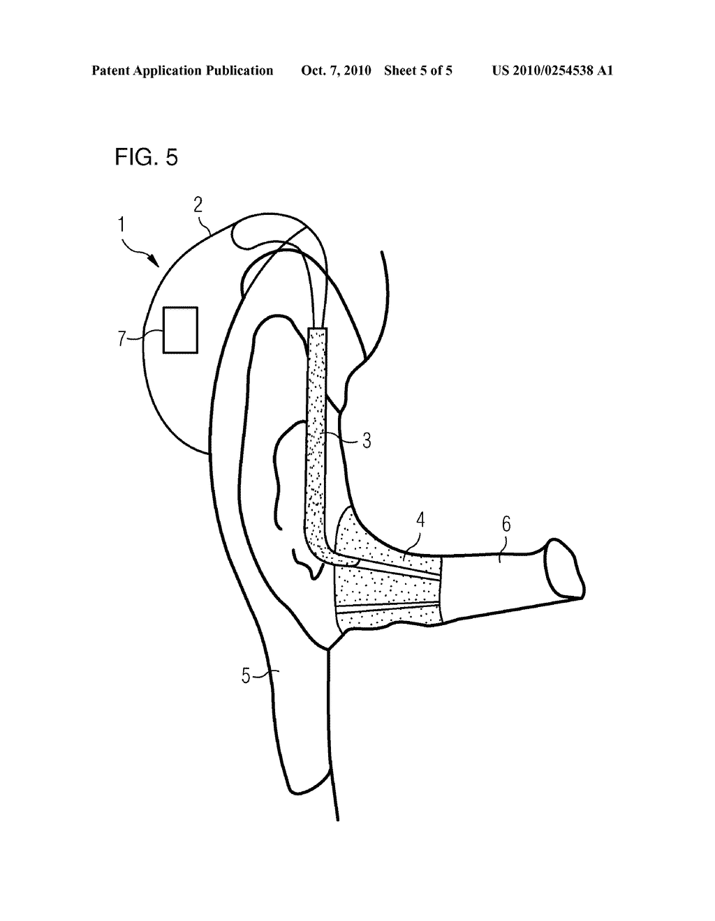 METHOD FOR LOUDNESS-BASED ADJUSTMENT OF THE AMPLIFICATION OF A HEARING AID AND ASSOCIATED HEARING AID - diagram, schematic, and image 06