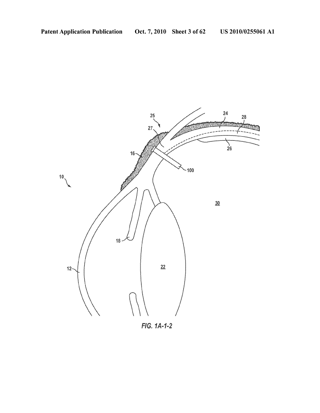 Posterior Segment Drug Delivery - diagram, schematic, and image 04