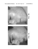 Liposomal ALA pharmaceutical and cosmeceutical compositions and methods of treatment diagram and image