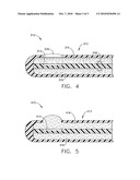 MEDICAL SYSTEM HAVING AN ULTRASOUND SOURCE AND AN ACOUSTIC COUPLING MEDIUM diagram and image