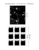 METHOD AND APPARATUS FOR MEDICAL IMAGING USING COMBINED NEAR-INFRARED OPTICAL TOMOGRAPHY, FLUORESCENT TOMOGRAPHY AND ULTRASOUND diagram and image