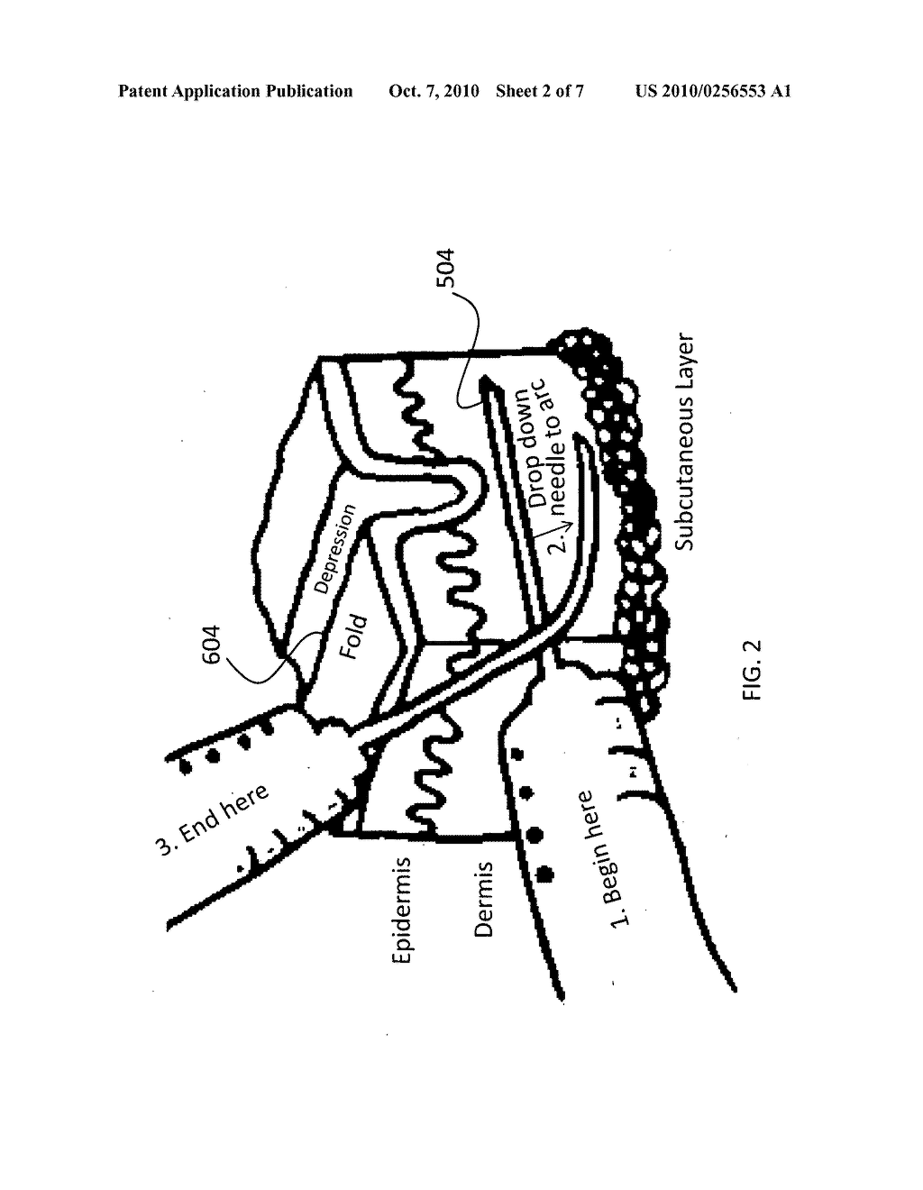 Method for injecting fillers into the dermis - diagram, schematic, and image 03