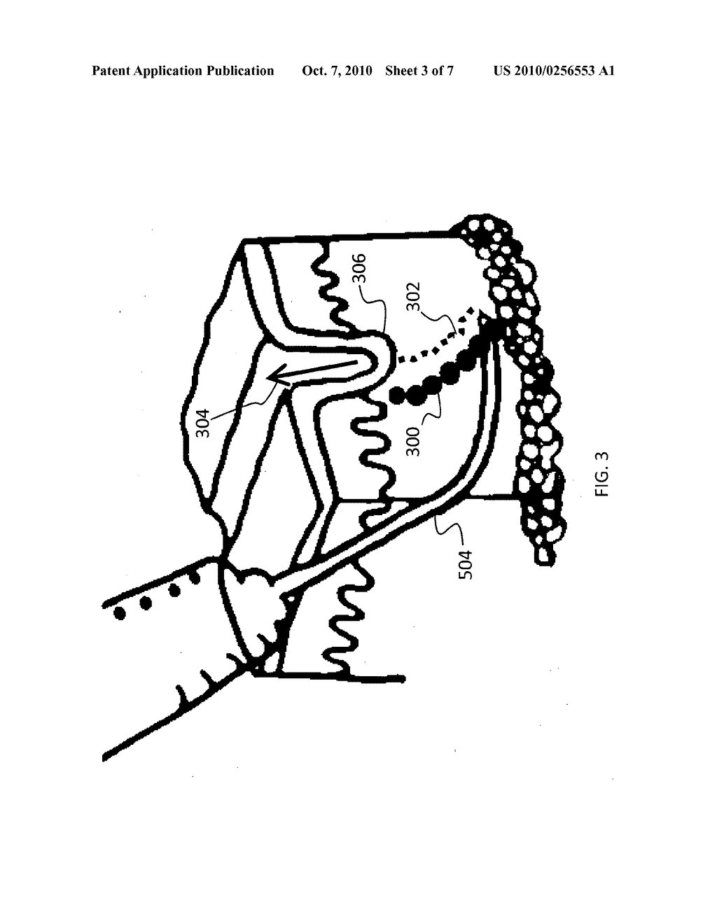 Method for injecting fillers into the dermis - diagram, schematic, and image 04