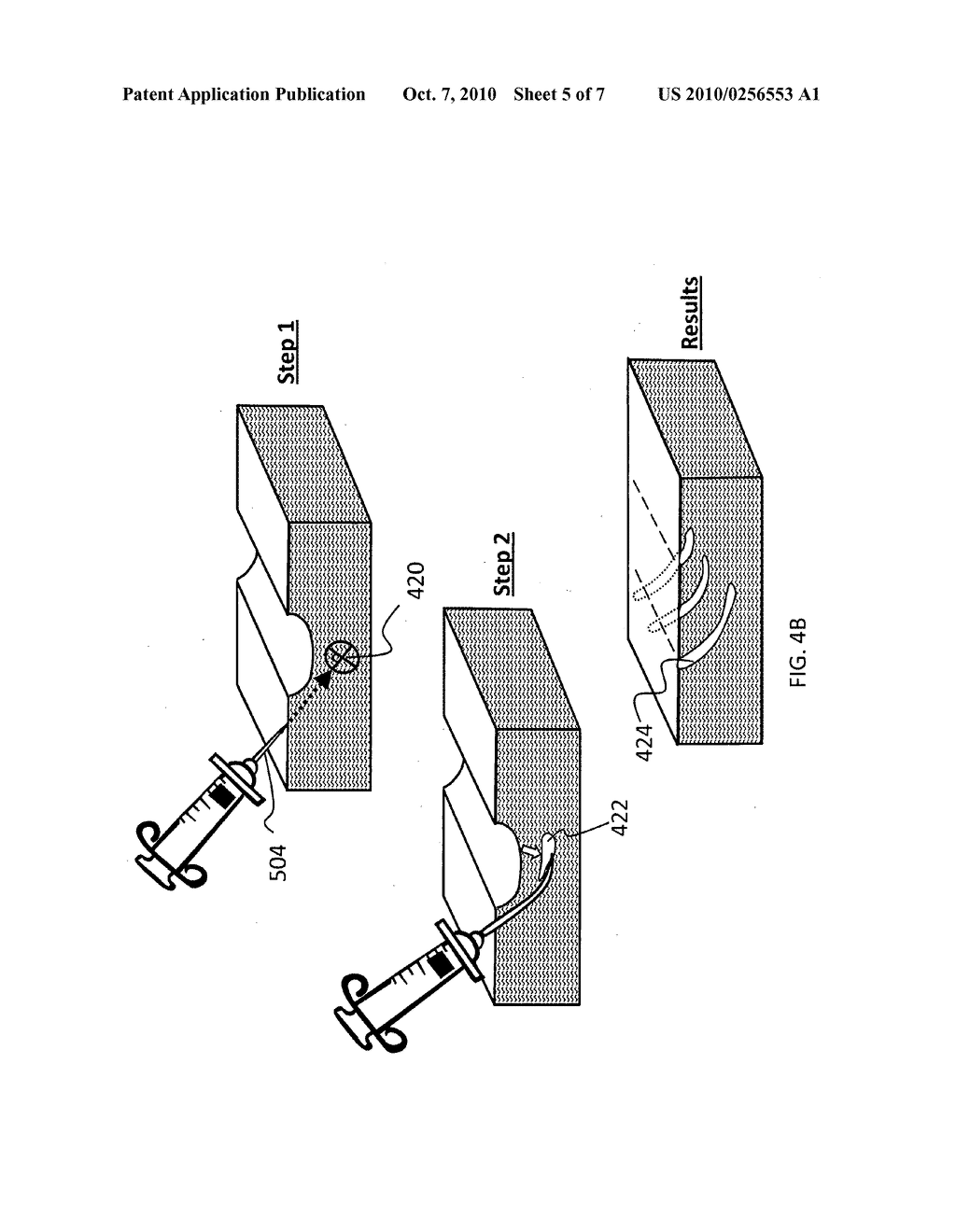 Method for injecting fillers into the dermis - diagram, schematic, and image 06