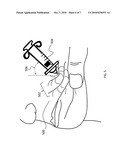 Method for injecting fillers into the dermis diagram and image