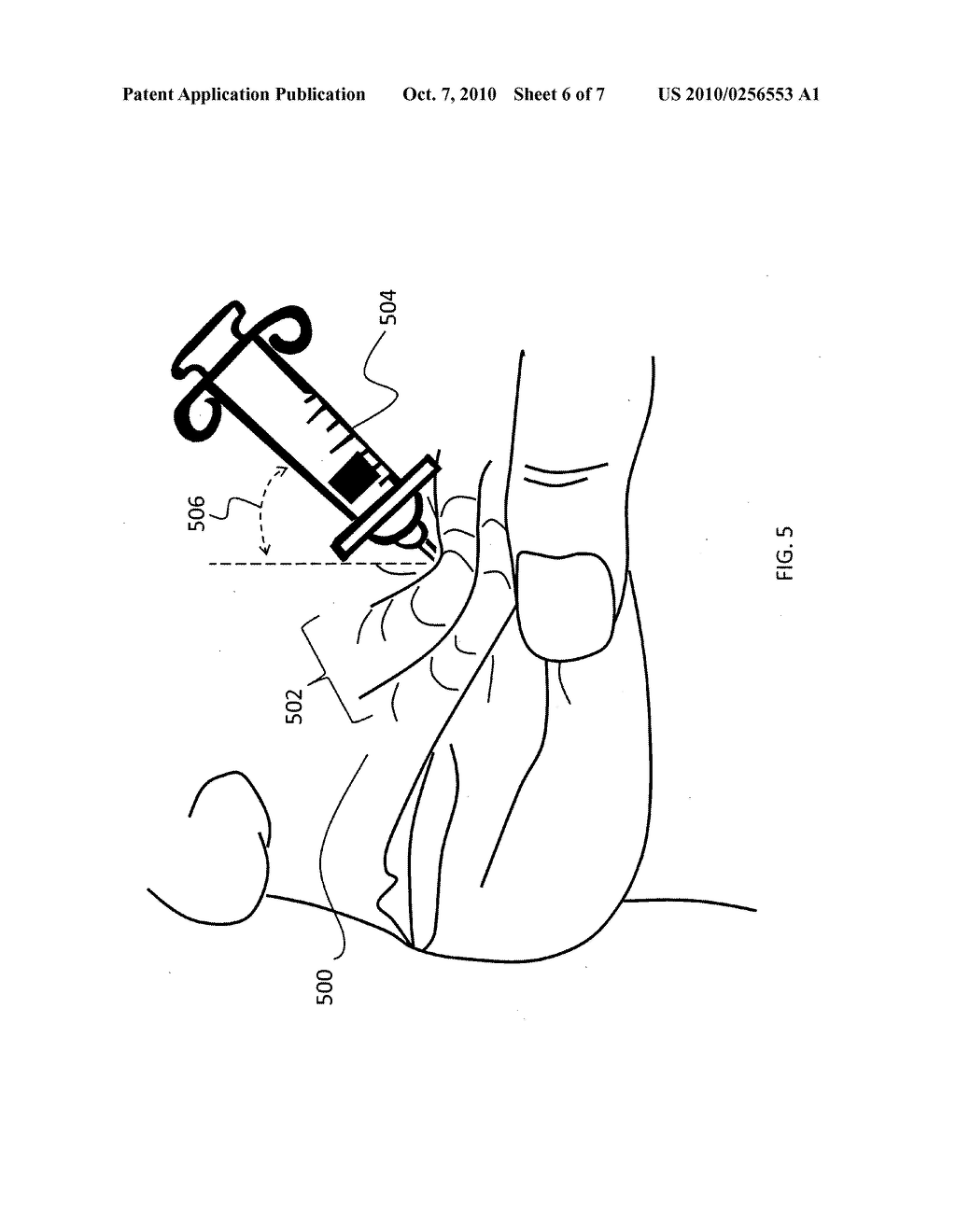Method for injecting fillers into the dermis - diagram, schematic, and image 07
