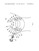 Method for injecting fillers into the dermis diagram and image