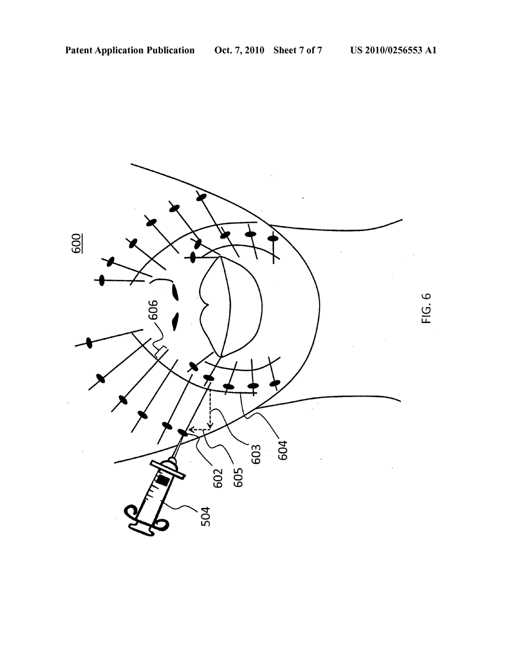 Method for injecting fillers into the dermis - diagram, schematic, and image 08