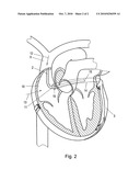 Device for the intermittent occlusion of the coronary sinus diagram and image