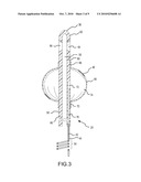 Method of Using a Partial-Length, Indwelling Prostatic Catheter Having a Coiled Inflation Tube as an Anchor diagram and image