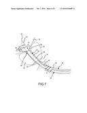 Method of Using a Partial-Length, Indwelling Prostatic Catheter Having a Coiled Inflation Tube as an Anchor diagram and image