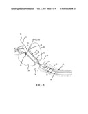 Method of Using a Partial-Length, Indwelling Prostatic Catheter Having a Coiled Inflation Tube as an Anchor diagram and image