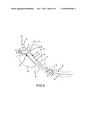 Method of Using a Partial-Length, Indwelling Prostatic Catheter Having a Coiled Inflation Tube as an Anchor diagram and image