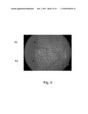 Patterned Laser Treatment diagram and image