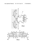 Intervertebral Implant diagram and image