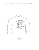 MINIMIZING HEMODYNAMIC COMPROMISE DURING POST-MI REMODELING CONTROL PACING diagram and image