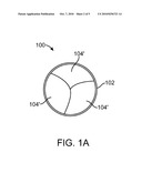 Prosthetic Valve With Device for Restricting Expansion diagram and image