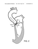 Prosthetic Valve With Device for Restricting Expansion diagram and image