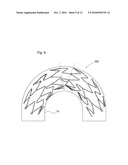 STENT diagram and image