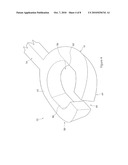 MODULAR STENT ASSEMBLY diagram and image