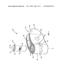 Method of Installation of Intervertebral Spacers diagram and image