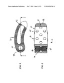 Method of Installation of Intervertebral Spacers diagram and image