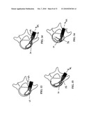 Method of Installation of Intervertebral Spacers diagram and image