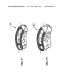 Method of Installation of Intervertebral Spacers diagram and image