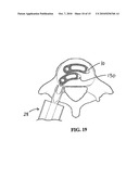 Method of Installation of Intervertebral Spacers diagram and image