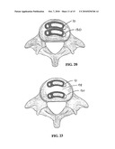 Method of Installation of Intervertebral Spacers diagram and image