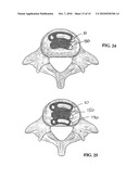 Method of Installation of Intervertebral Spacers diagram and image