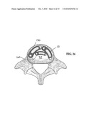 Method of Installation of Intervertebral Spacers diagram and image