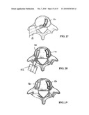 Method of Installation of Intervertebral Spacers diagram and image