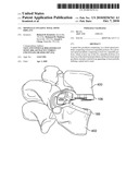 MINIMALLY INVASIVE TOTAL SPINE IMPLANT diagram and image