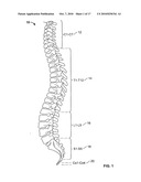 MINIMALLY INVASIVE TOTAL SPINE IMPLANT diagram and image