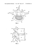 MINIMALLY INVASIVE TOTAL SPINE IMPLANT diagram and image