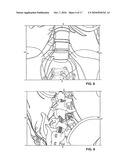 MINIMALLY INVASIVE TOTAL SPINE IMPLANT diagram and image