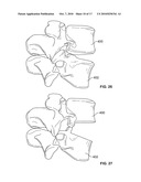 MINIMALLY INVASIVE TOTAL SPINE IMPLANT diagram and image