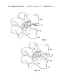 MINIMALLY INVASIVE TOTAL SPINE IMPLANT diagram and image