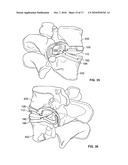 MINIMALLY INVASIVE TOTAL SPINE IMPLANT diagram and image