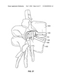 MINIMALLY INVASIVE TOTAL SPINE IMPLANT diagram and image