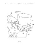 MINIMALLY INVASIVE TOTAL SPINE IMPLANT diagram and image